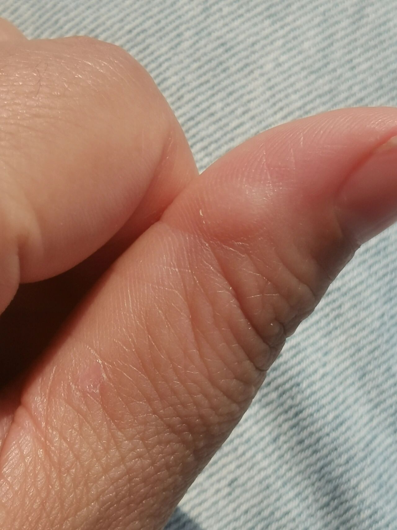 大拇指旁边长了一个硬疙瘩,不疼不痒,不知道什么原因?