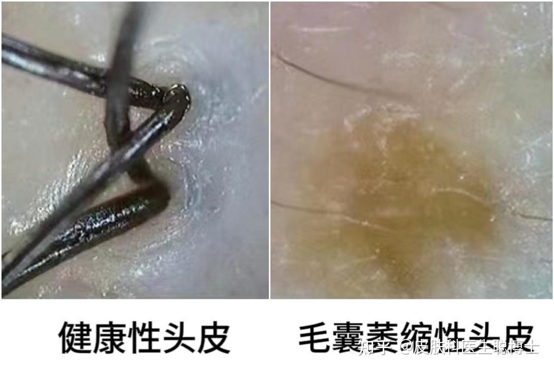 头顶头发有很多很短很细小的毛发一直长不长这些毛囊是萎缩了还是坏死