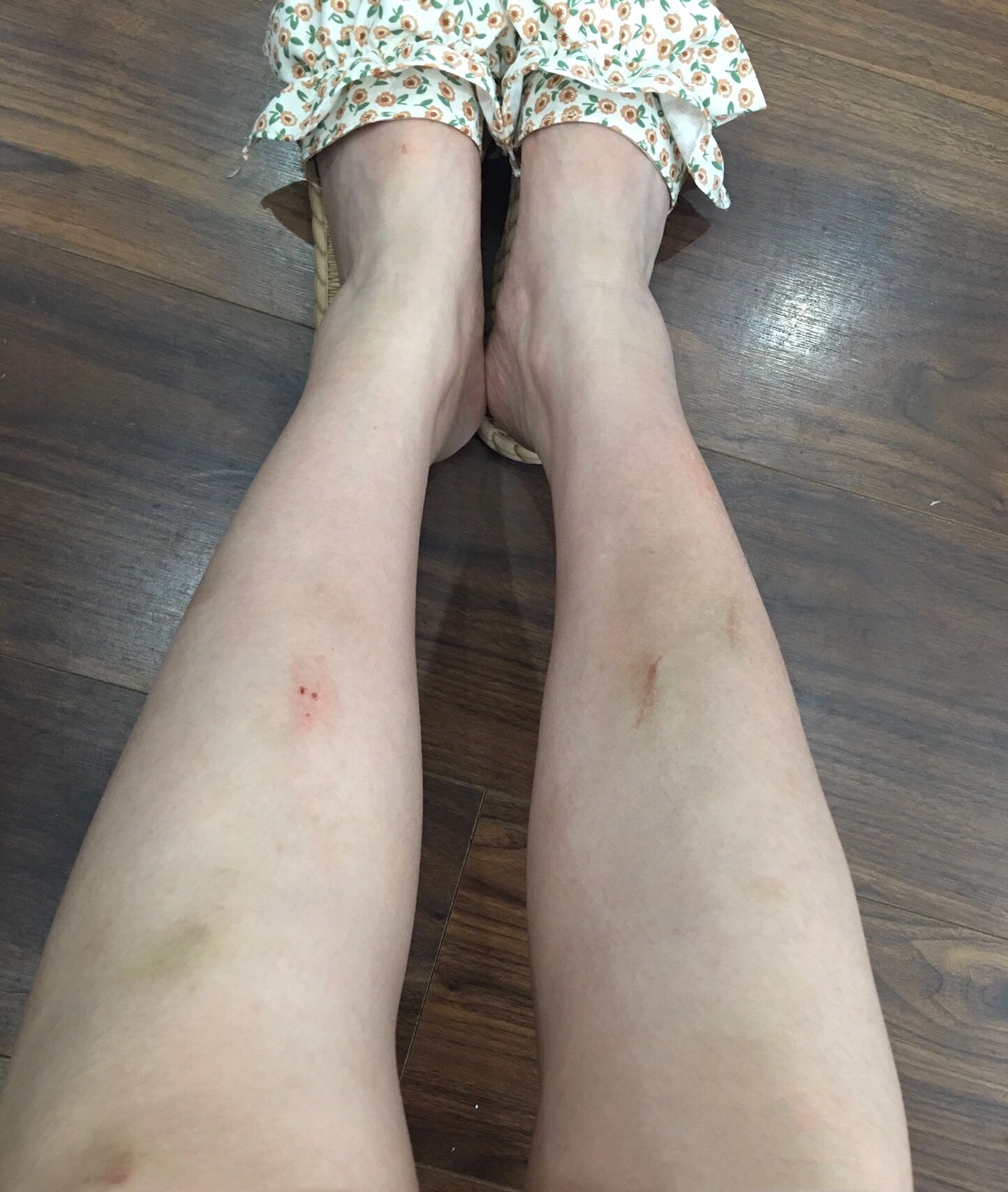 是不是女生腿上总会莫名其妙出现一些淤青?