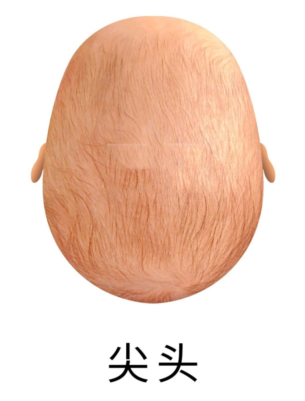 尖头舟状头菱形头矫正方法 7815 前言:10年来,居易专研婴儿头型