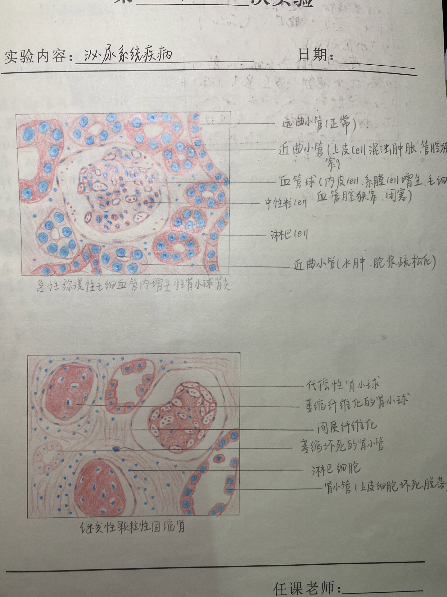 肾结核手绘图图片