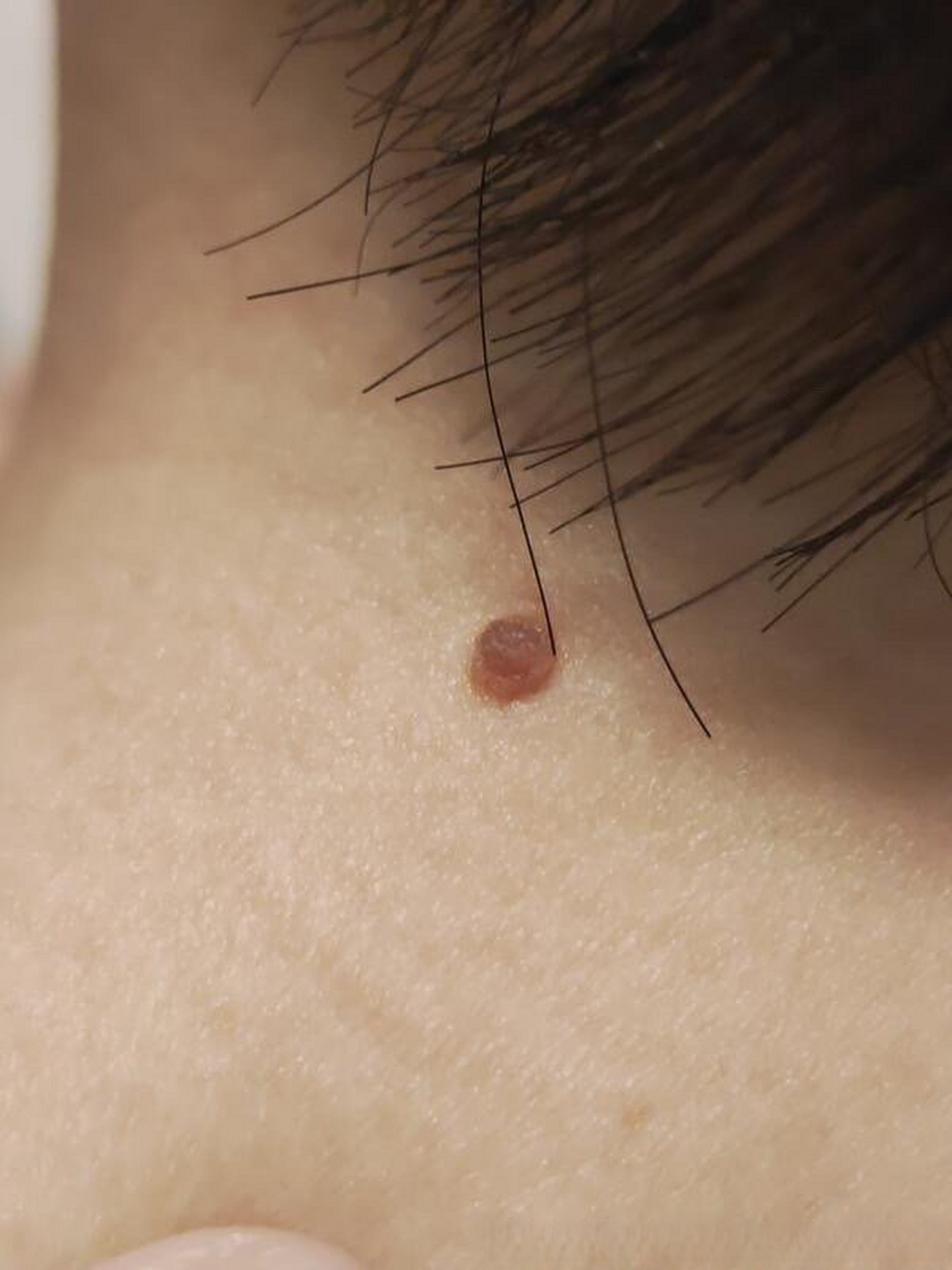 健康美好生活计划# 孕28周,背部,私处增生小肉瘤.