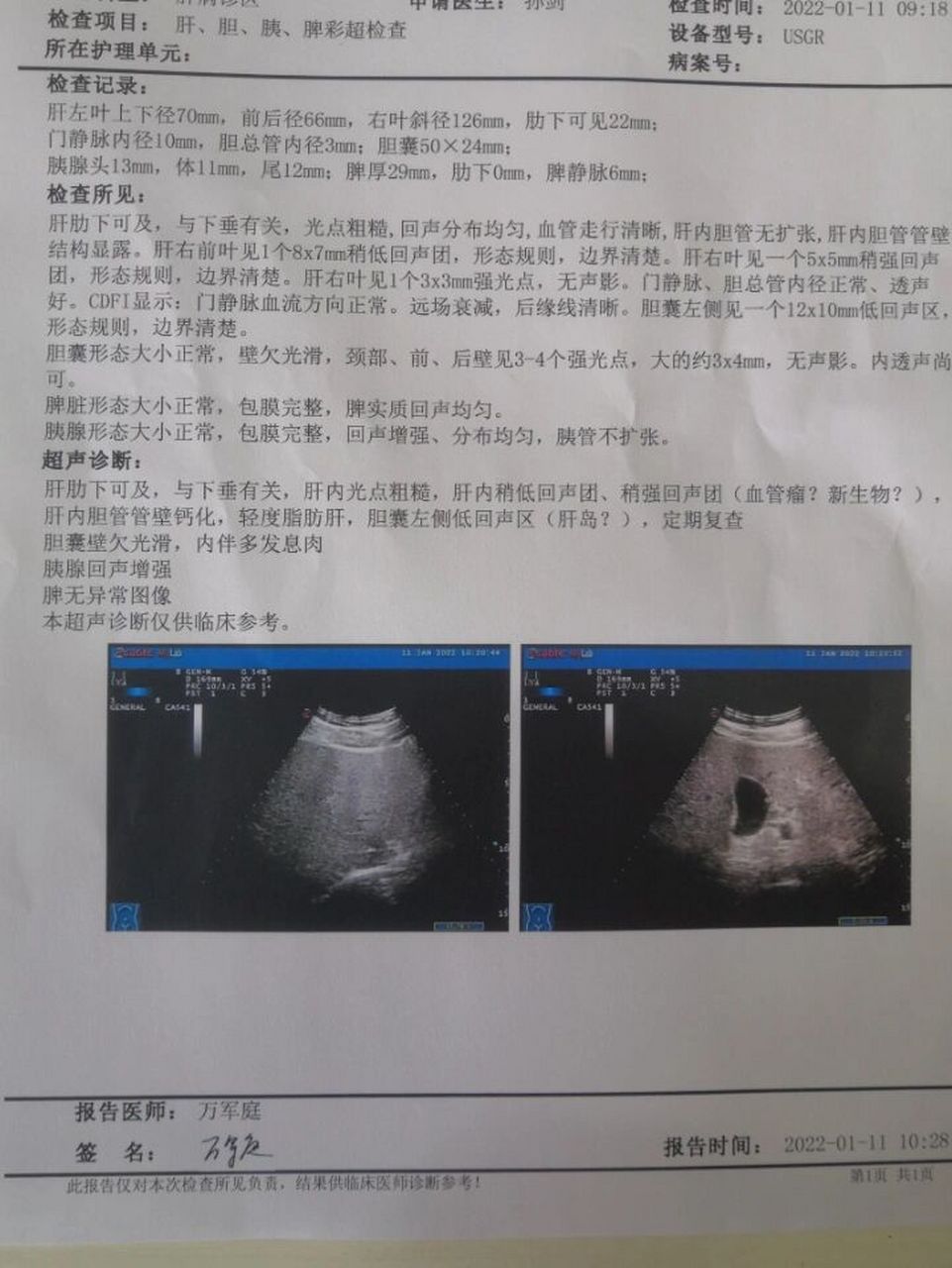 肝脏的常规检查-肝功能肝脏b超纤维化扫描 肝脏不痛不痒,一有问题