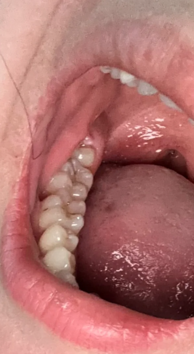 智齿为什么会发炎 智齿为什么会发炎