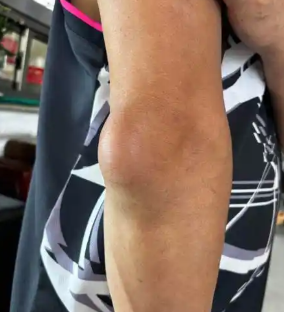 胳膊肘突然起个大软包什么原因?