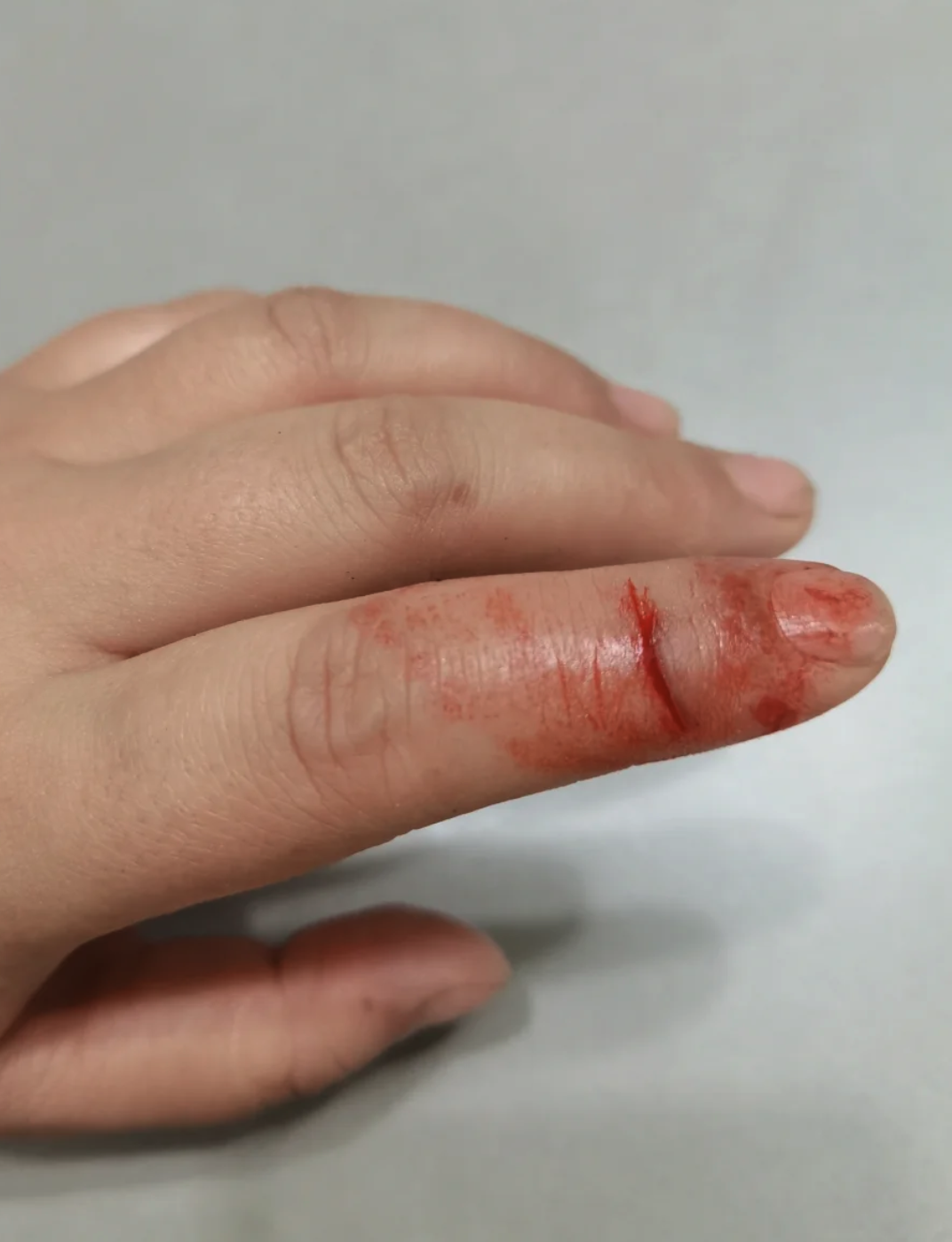 有时候伤口很小,不流血也不疼,当时没注意到,后来才发现,就以为是"无