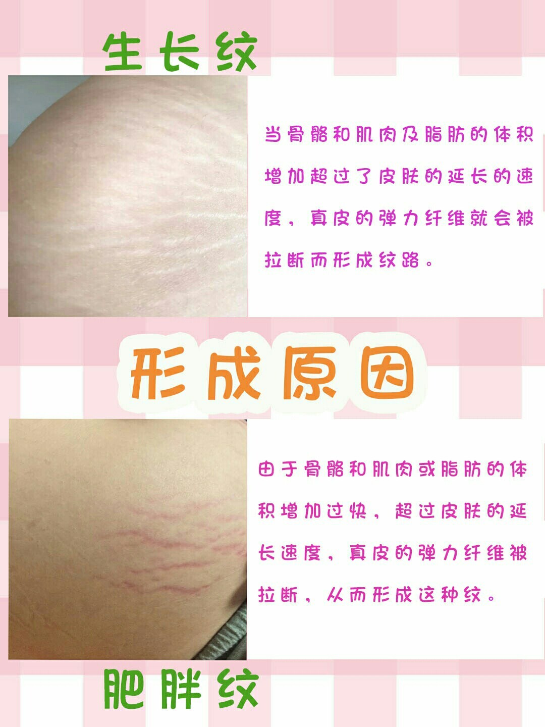 好物分享|祛生长纹97肥胖纹干货大合集 昨天发了一篇去除生长纹的