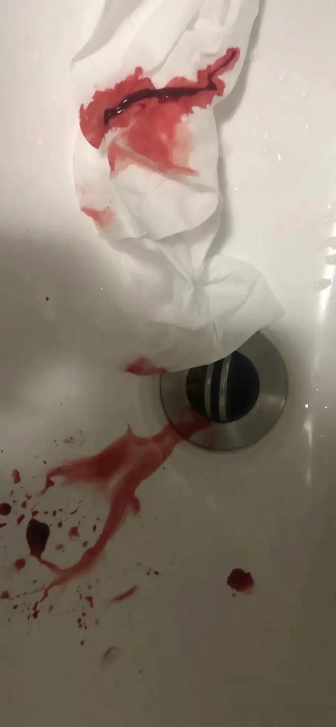 真实吐血的图片吐血图片真实照片 出血吐血照片 真实吐血图片吐血图片