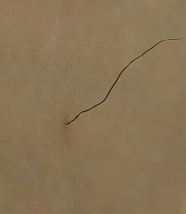 胸上总是反复长一根很粗的汗毛怎么回事?