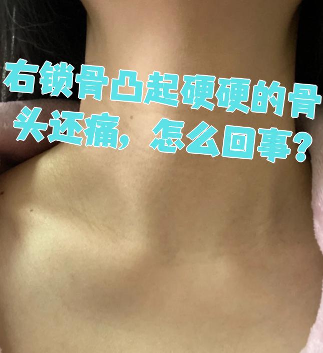 右锁骨凸起一块硬骨头还疼,常见原因有两种:锁骨损伤和软组织感染