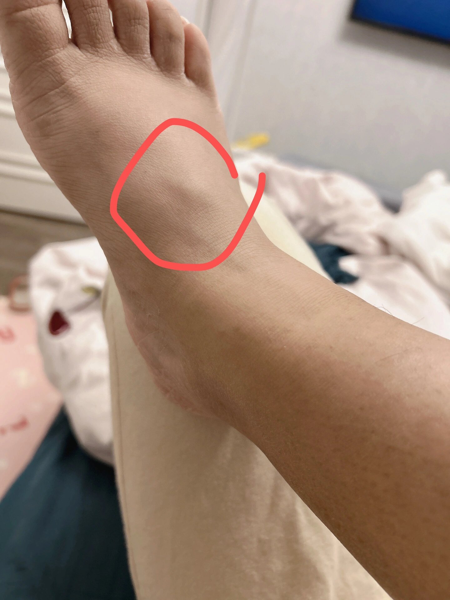 脚背上有一个硬鼓包 医生说是囊肿