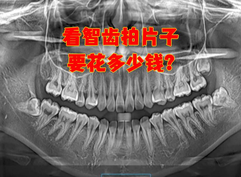 看智齿拍片子要花多少钱?