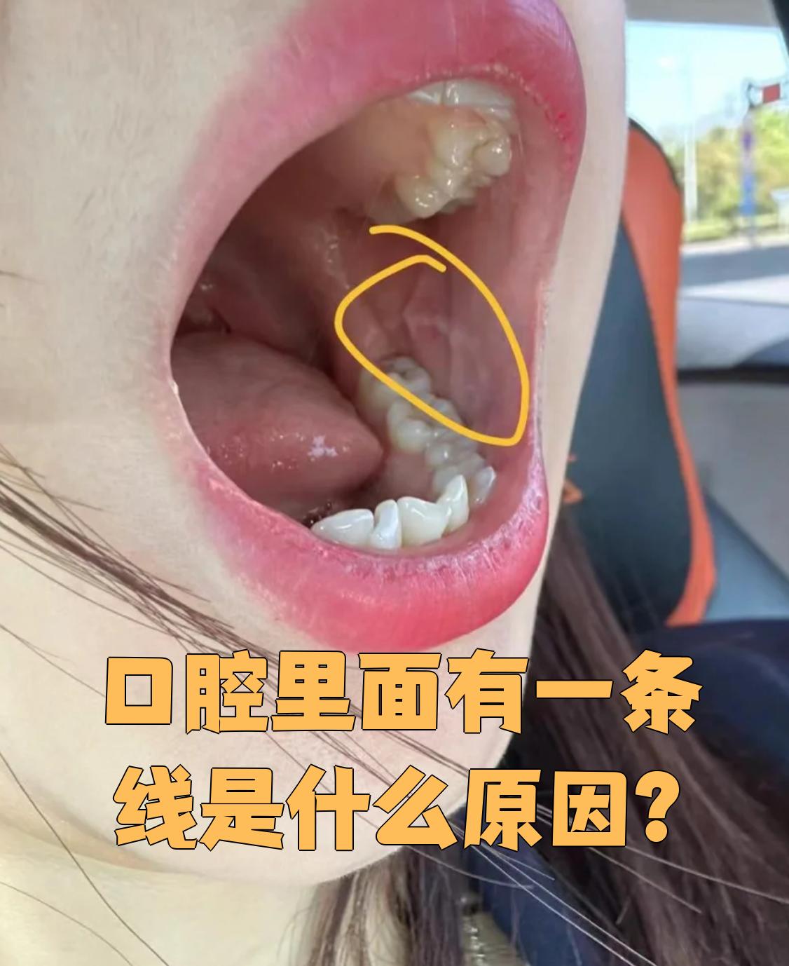 口腔里出现一条线可能由多种原因引起,最常见的是颊白线,也可能是