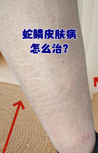 蛇鳞皮肤病,即鱼鳞病,是一种遗传性角化障碍性皮肤病