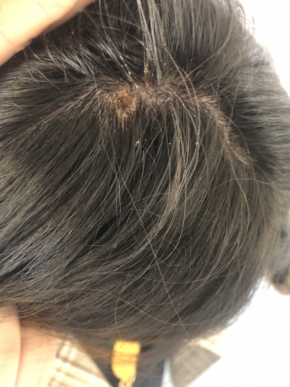 头皮纤维瘤 这个小肉瘤已经跟随我将近20年了,趁着今年年假不能出去