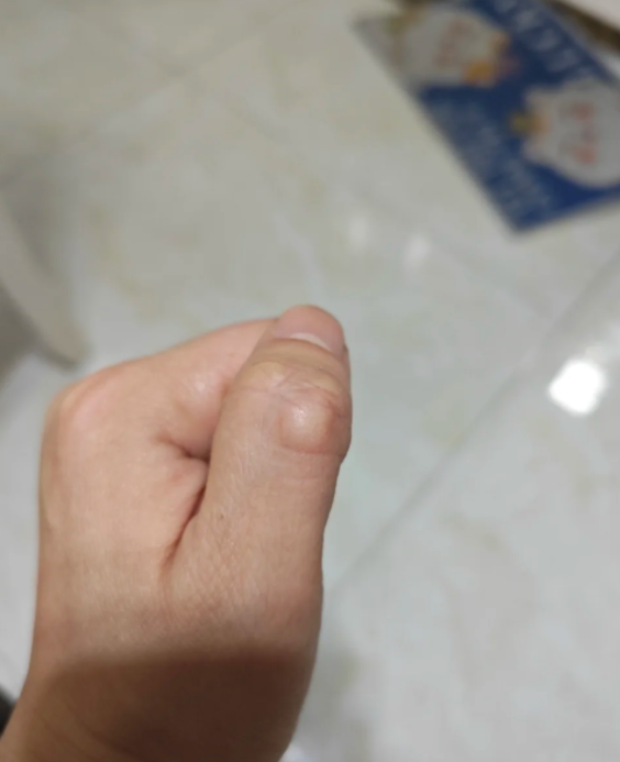 手指关节长了个硬包而且一按就疼,常见原因有三种:腱鞘囊肿,狭窄性