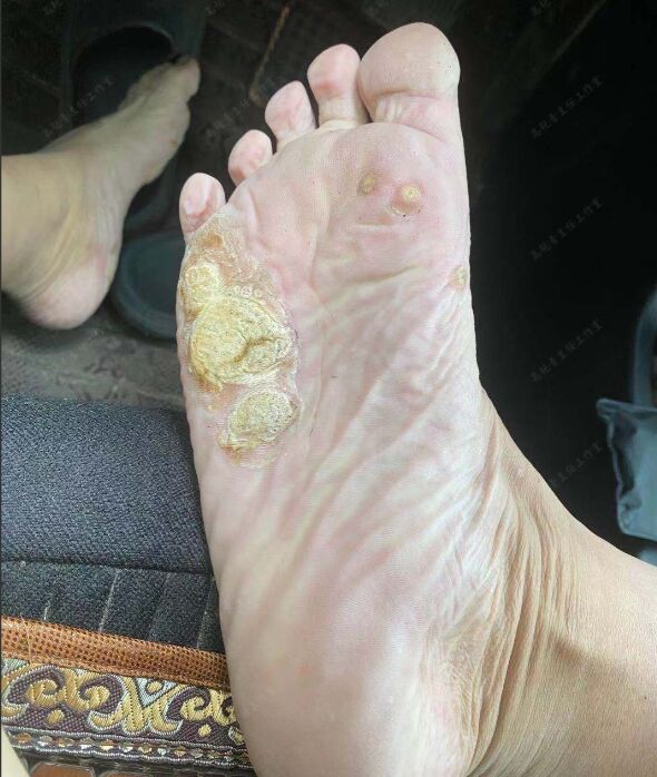 跖疣,是hpv病毒感染导致的,小的跖疣冷冻一下就可以了,如果像这位患者