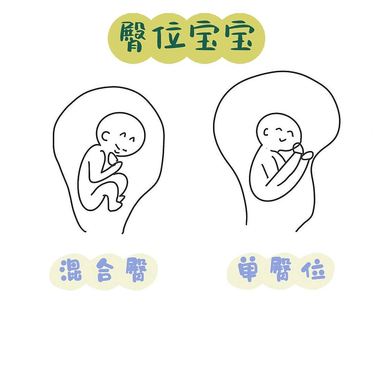 详解臀位宝宝出生的那些事!