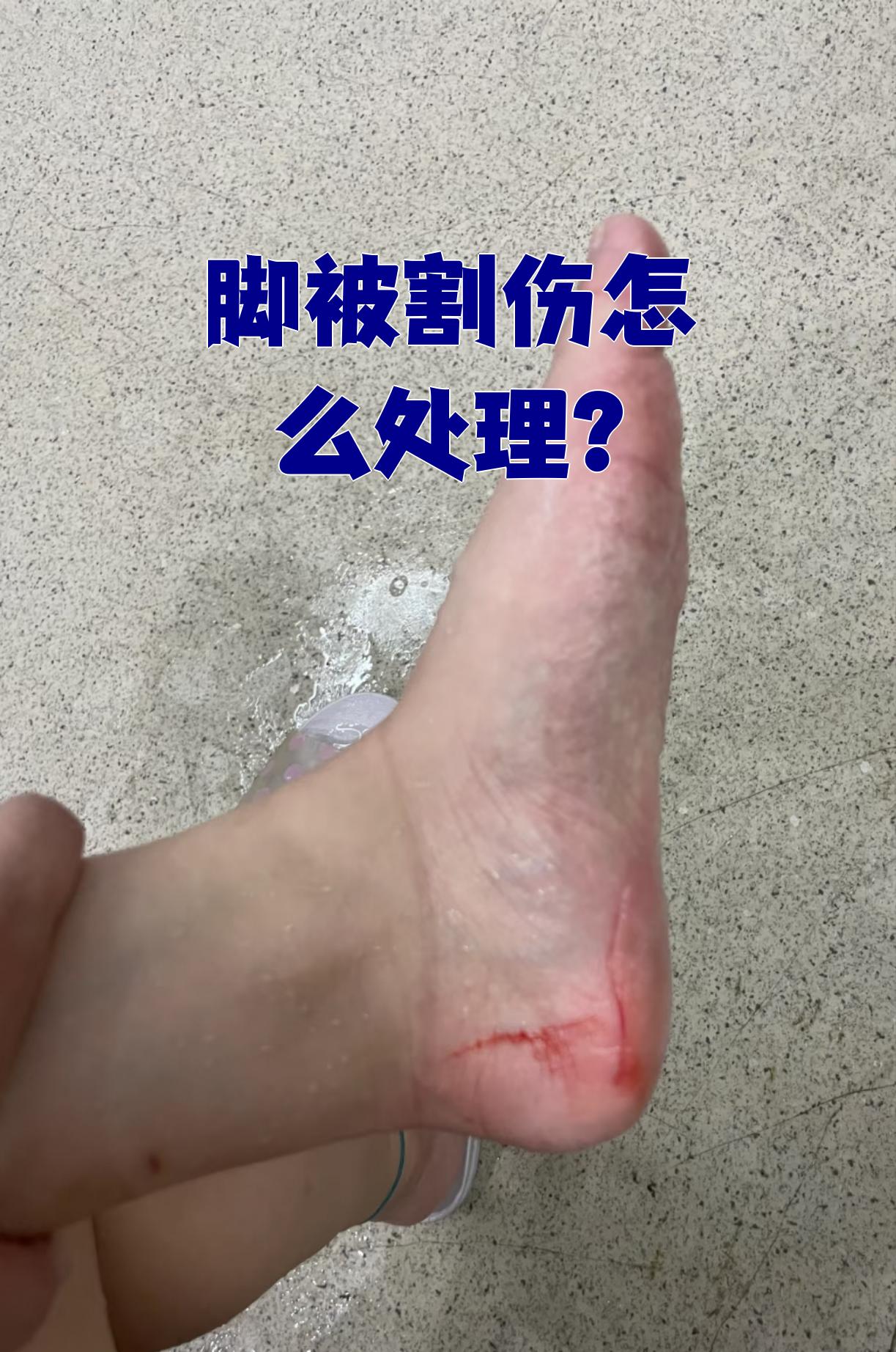 脚被割伤后,首先要看伤口有多深