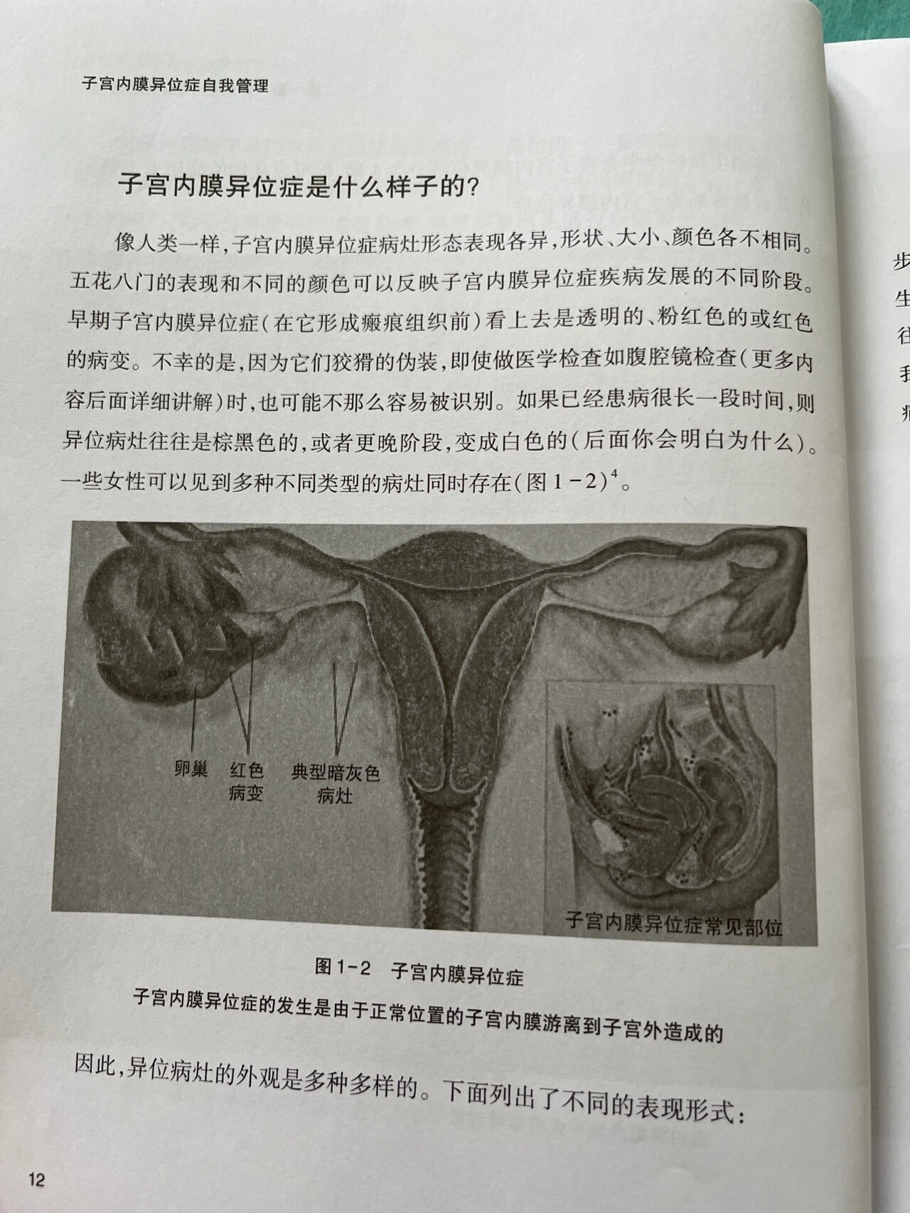 子宫内膜异位症的样子(腺肌症) 我跟很多我们群里的病友说.