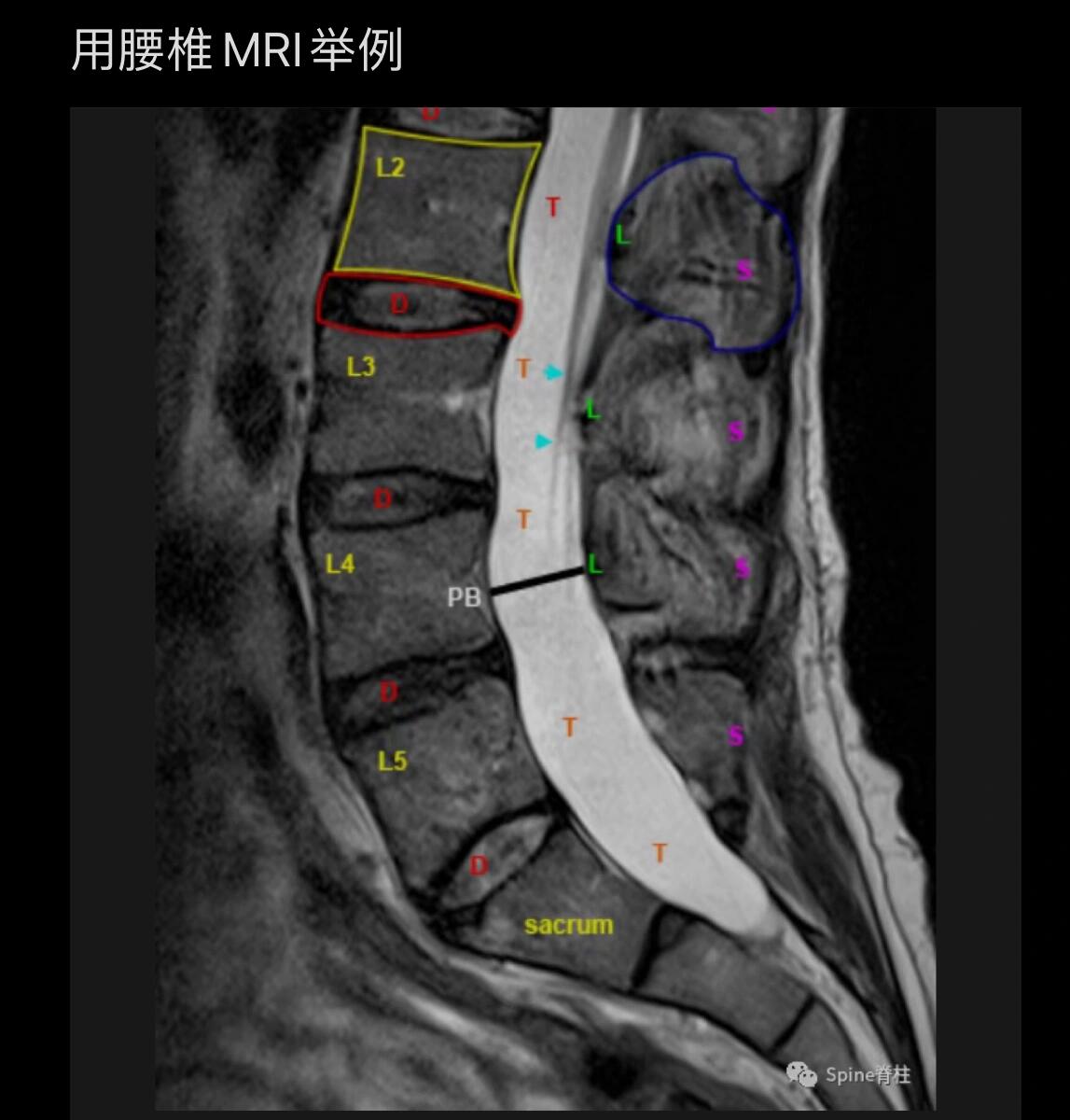 腰椎核磁图解图片