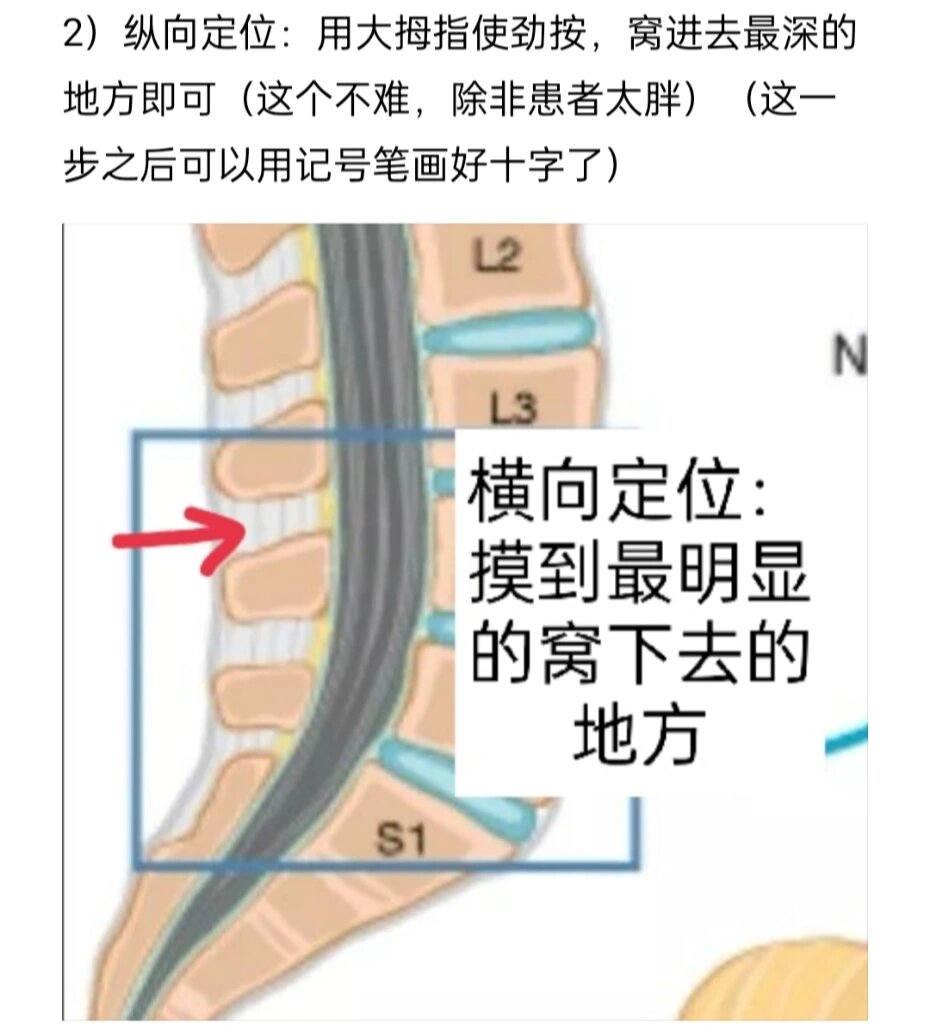 骨穿定位示意图图片