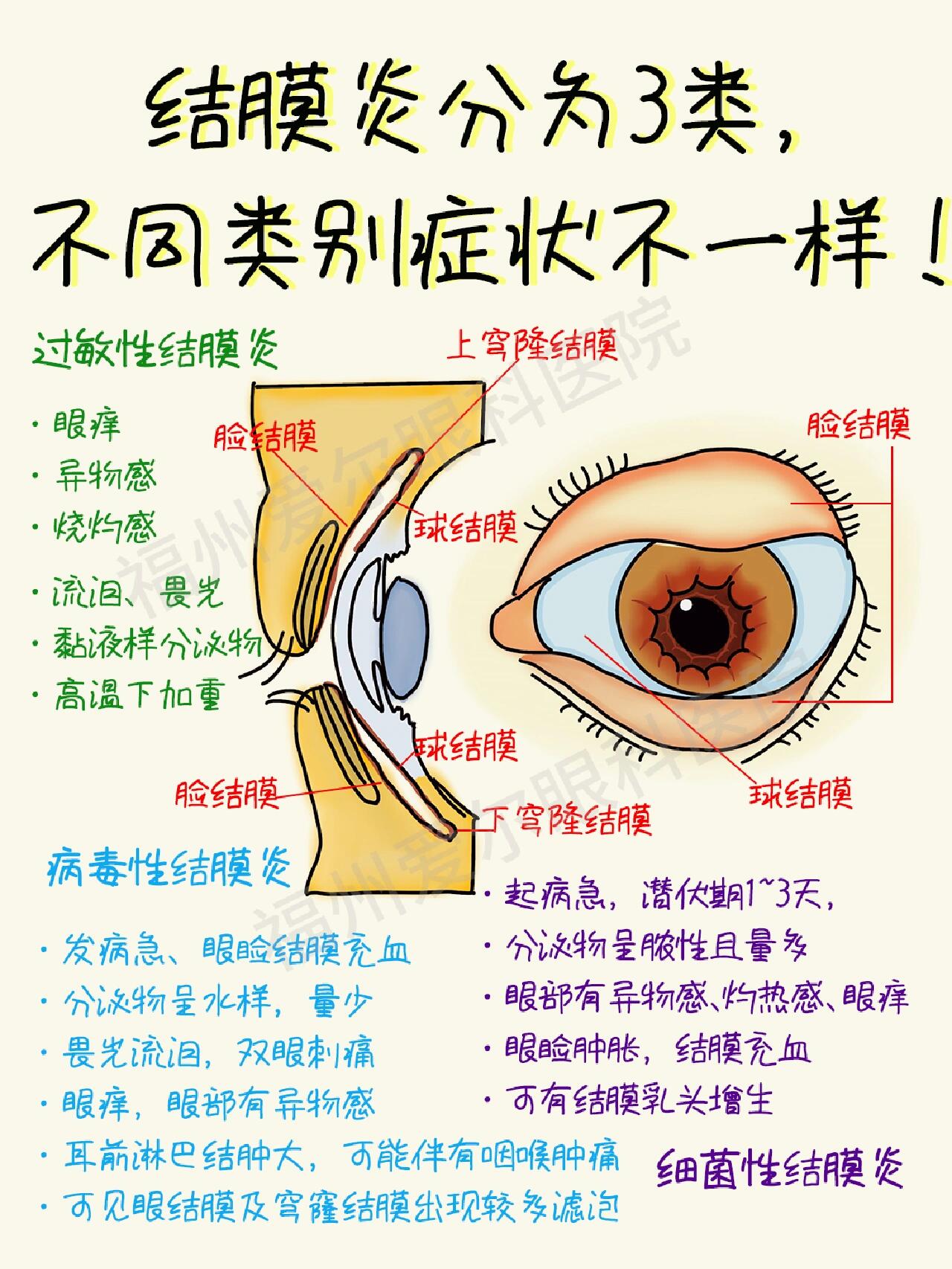 结膜炎分3类73不同类别症状不一样95