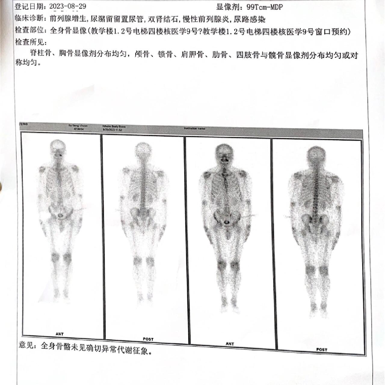 全身骨显像报告解读图片