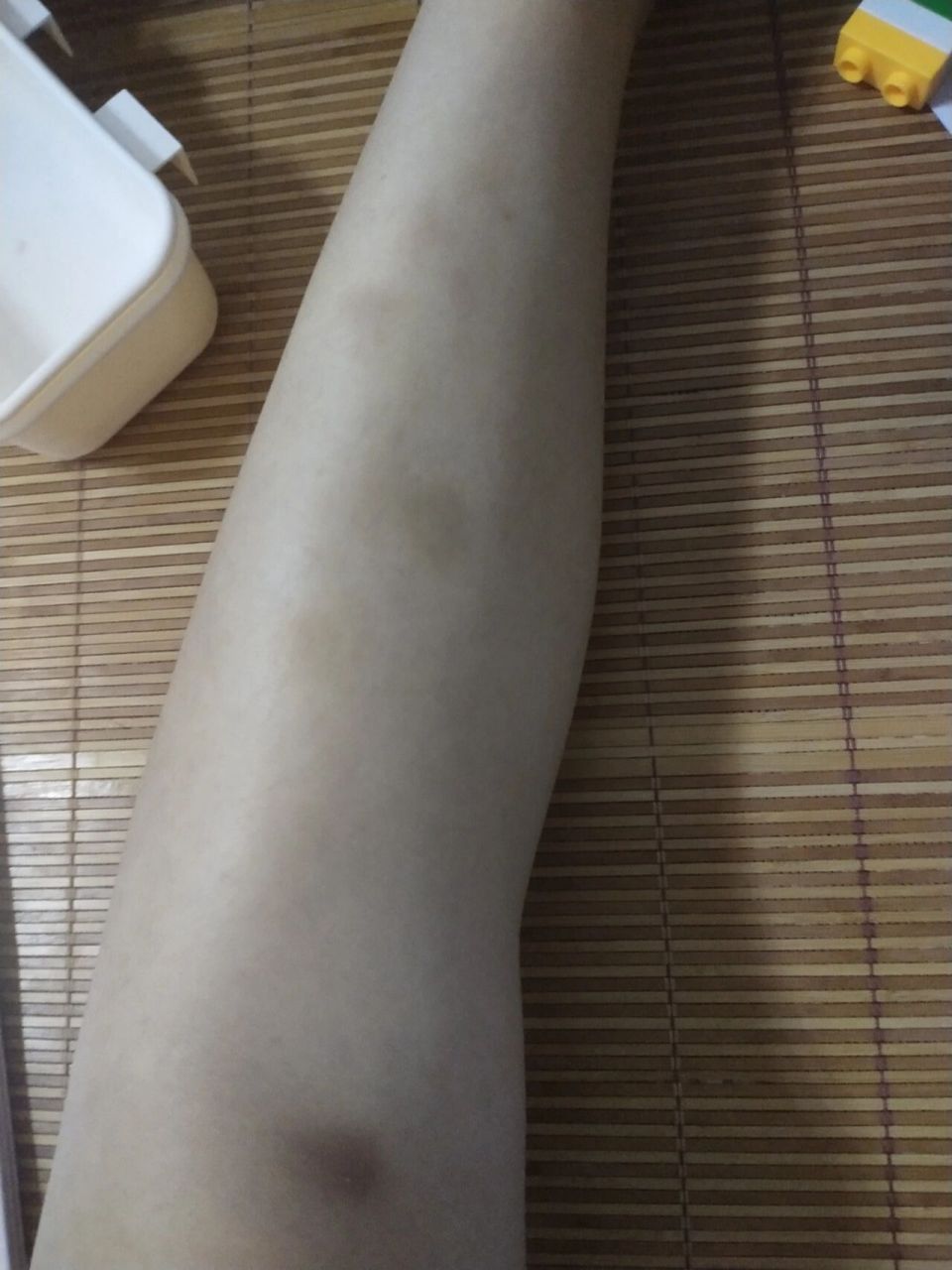 有谁知道这淤青咋回事啊 莫名其妙就发现腿上有淤青,也不觉得磕到哪里