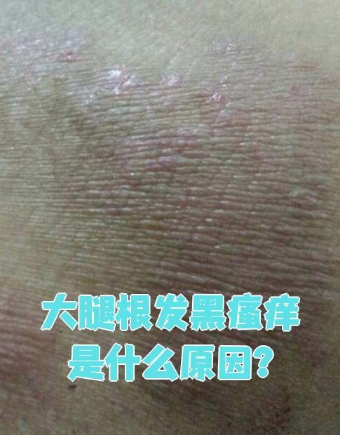 大腿根发黑瘙痒常见的原因包括黑棘皮病,股癣和湿疹