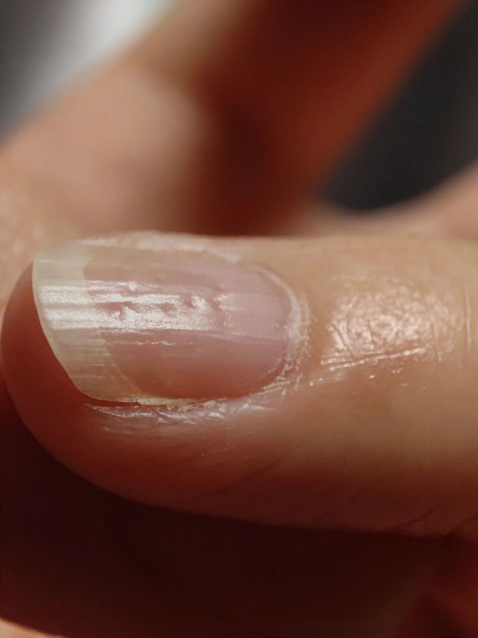 友友们指甲有这种小坑和竖纹是怎么回事求解 友友们指甲有这种小坑和