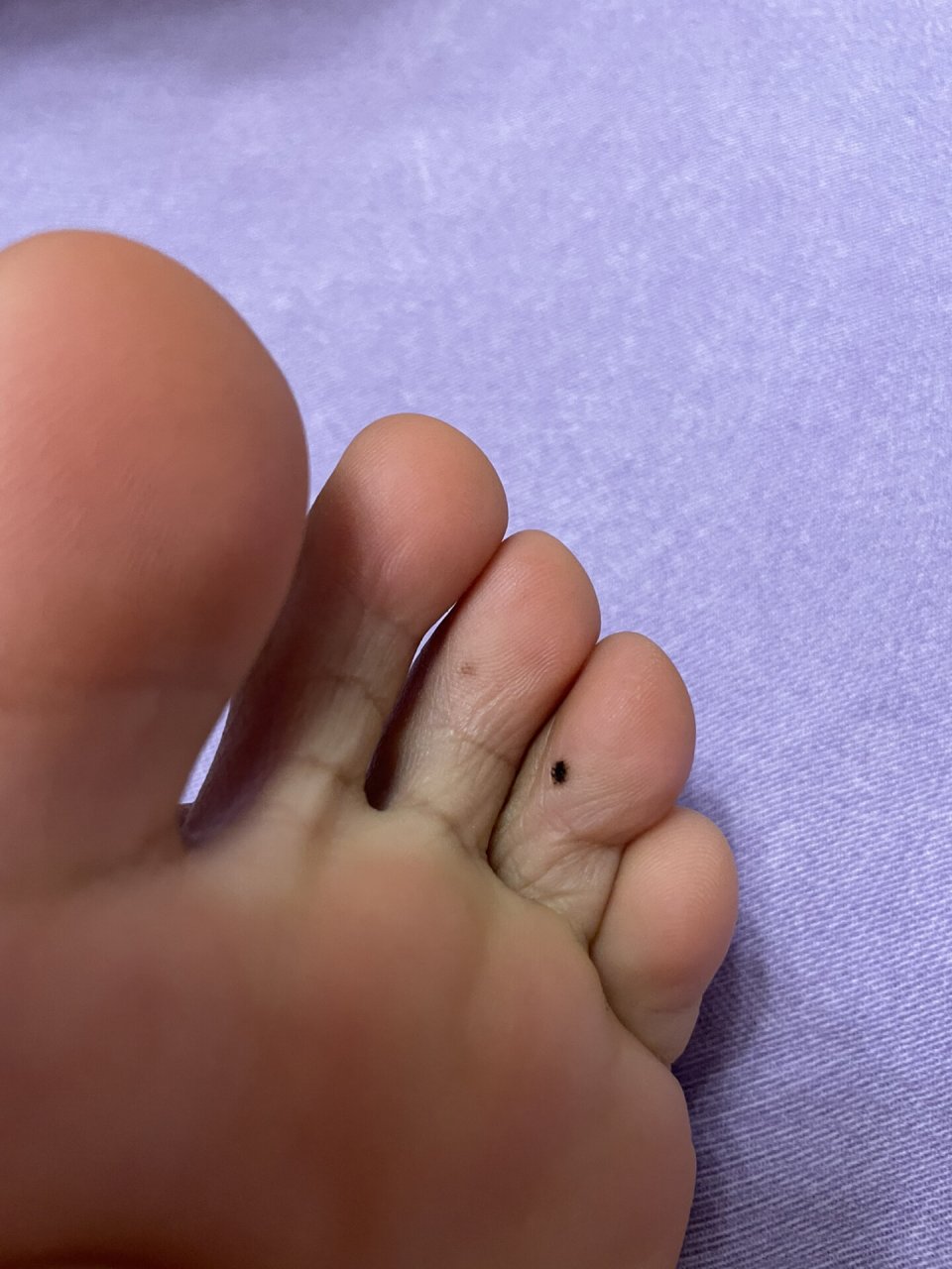 脚上近几年长了一个边缘不规则的黑痣,这个月,旁边脚趾同样的位置隐约