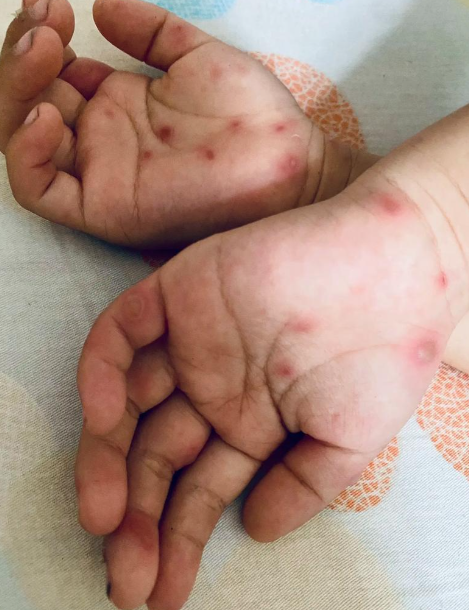 蚊子为什么喜欢咬小孩