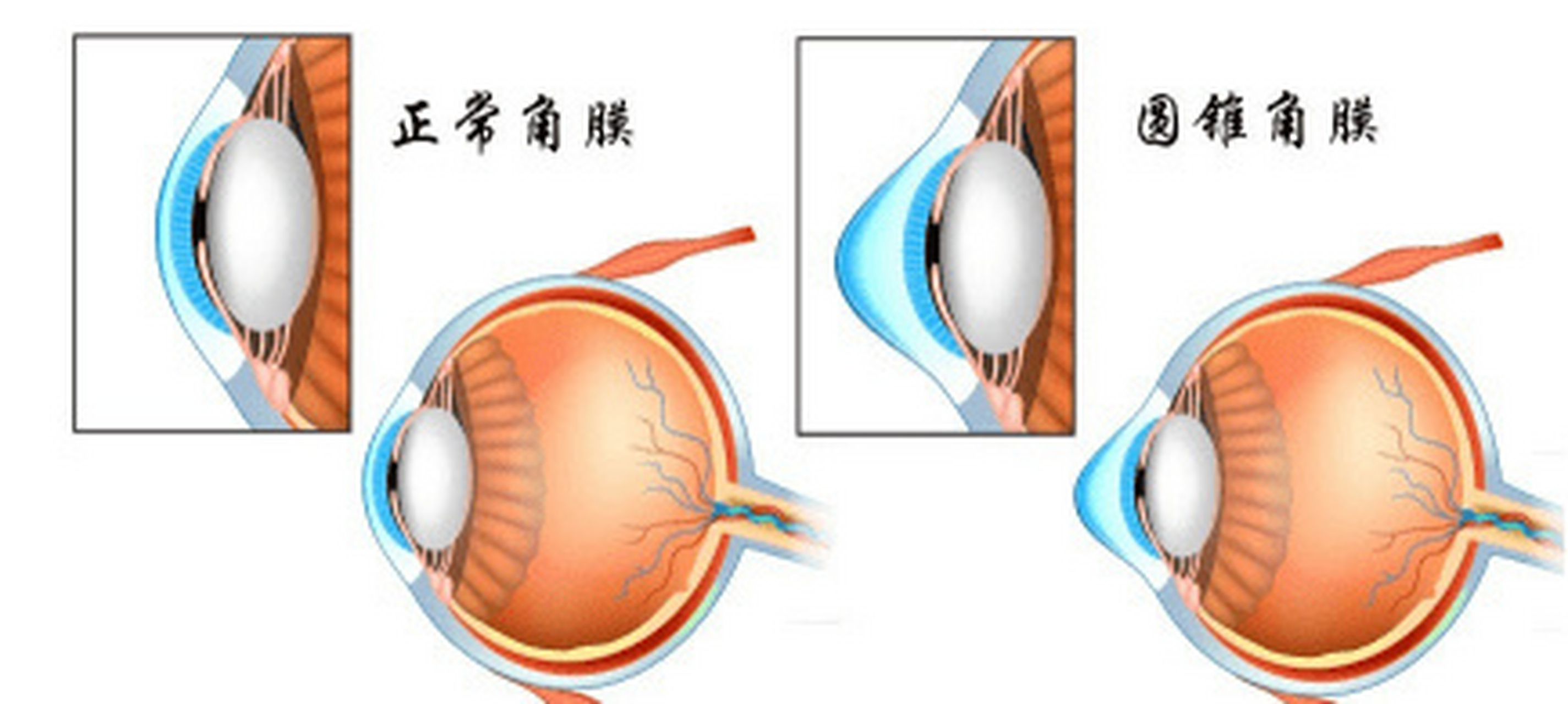 揉眼睛时角膜受到摩擦,很容易变薄,变形,甚至变得接近圆锥形