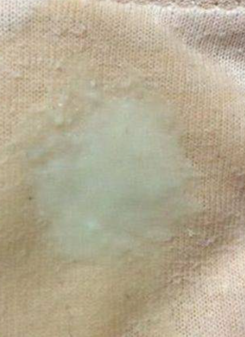 男人尿完后出现白色液体,这种情况叫尿滴白,通常是前列腺液