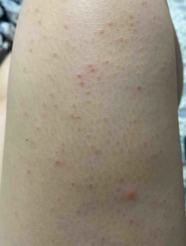 毛囊炎通常是细菌感染造成的,皮肤会红肿疼痛