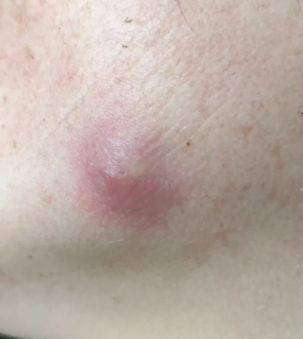 背上长了个硬痘痘,可能是痤疮,疖,毛囊炎或皮脂腺囊肿