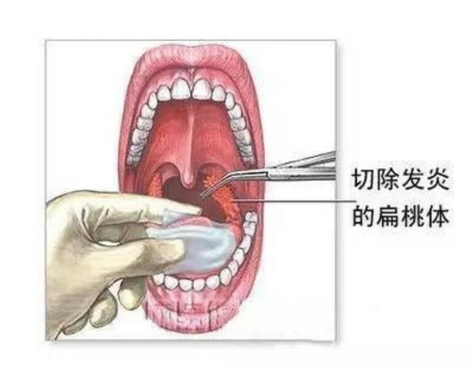 扁桃体肿大如何治疗图片