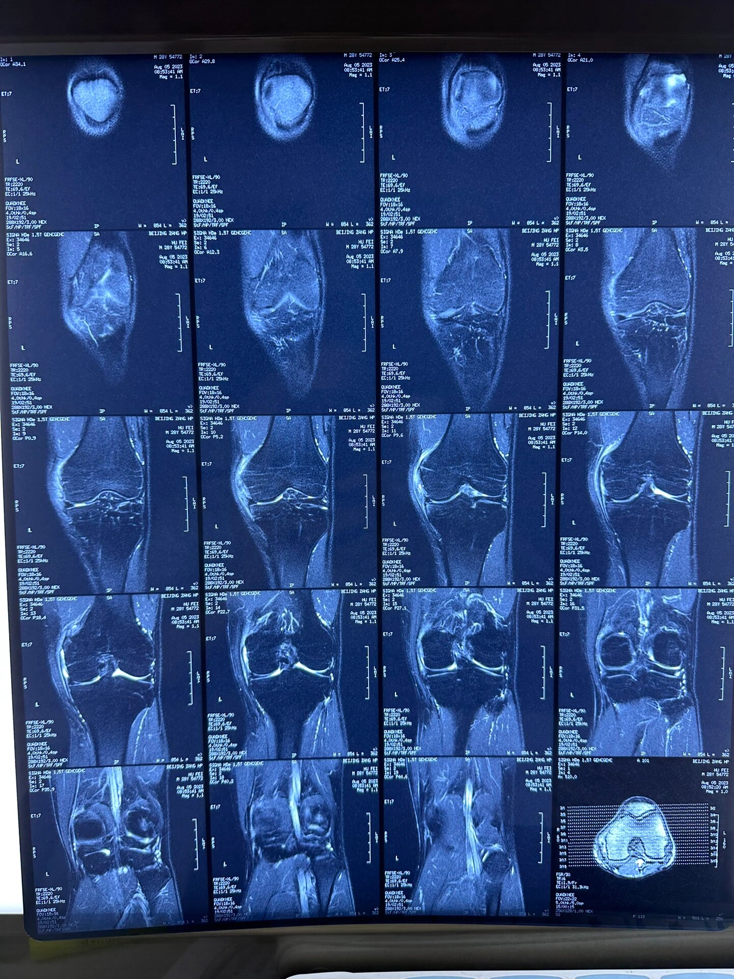 膝盖韧带核磁结果出来了
