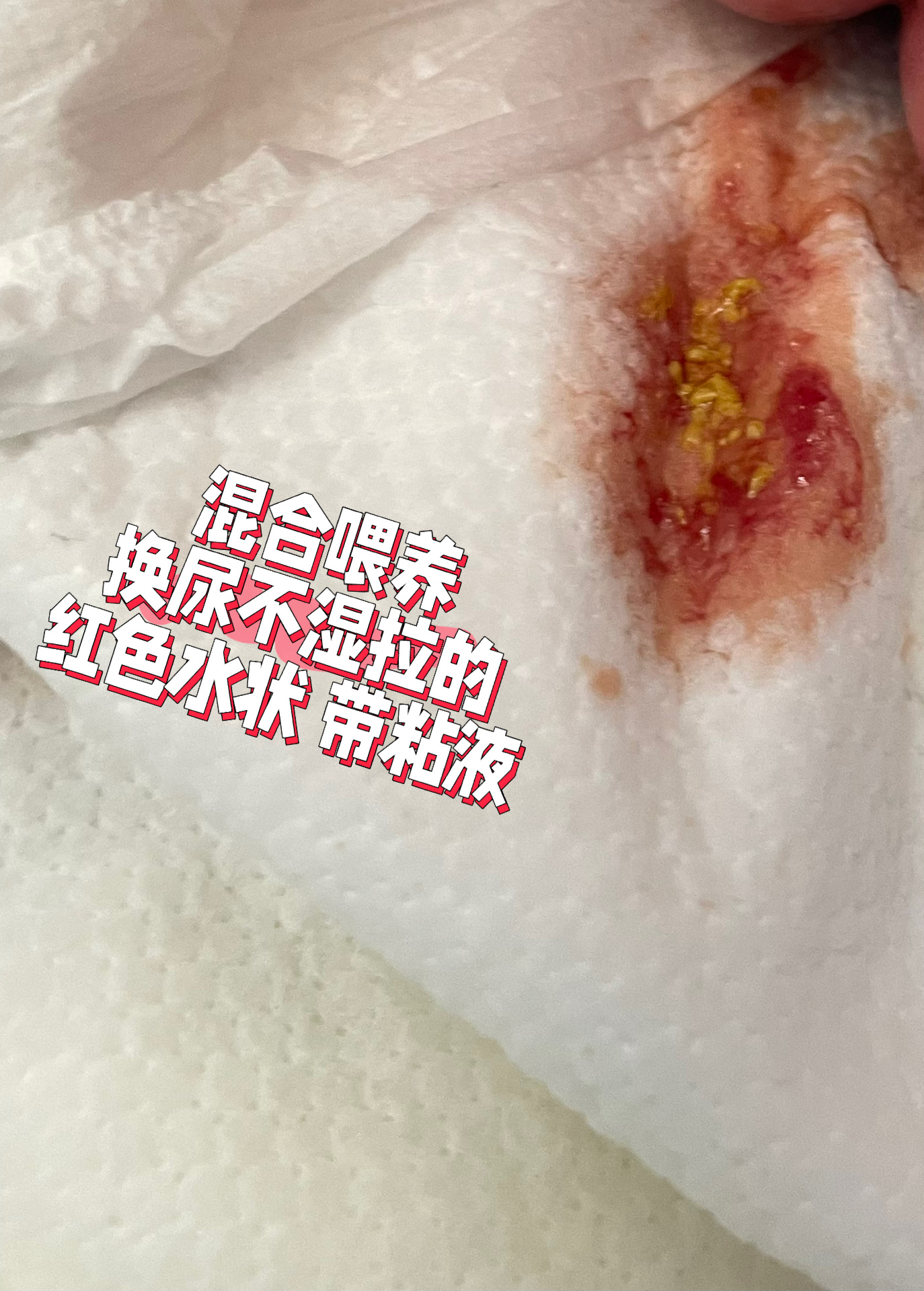 62天宝宝便便有红色血丝,棕褐色粘液   宝宝50几天开始大便有红色水状