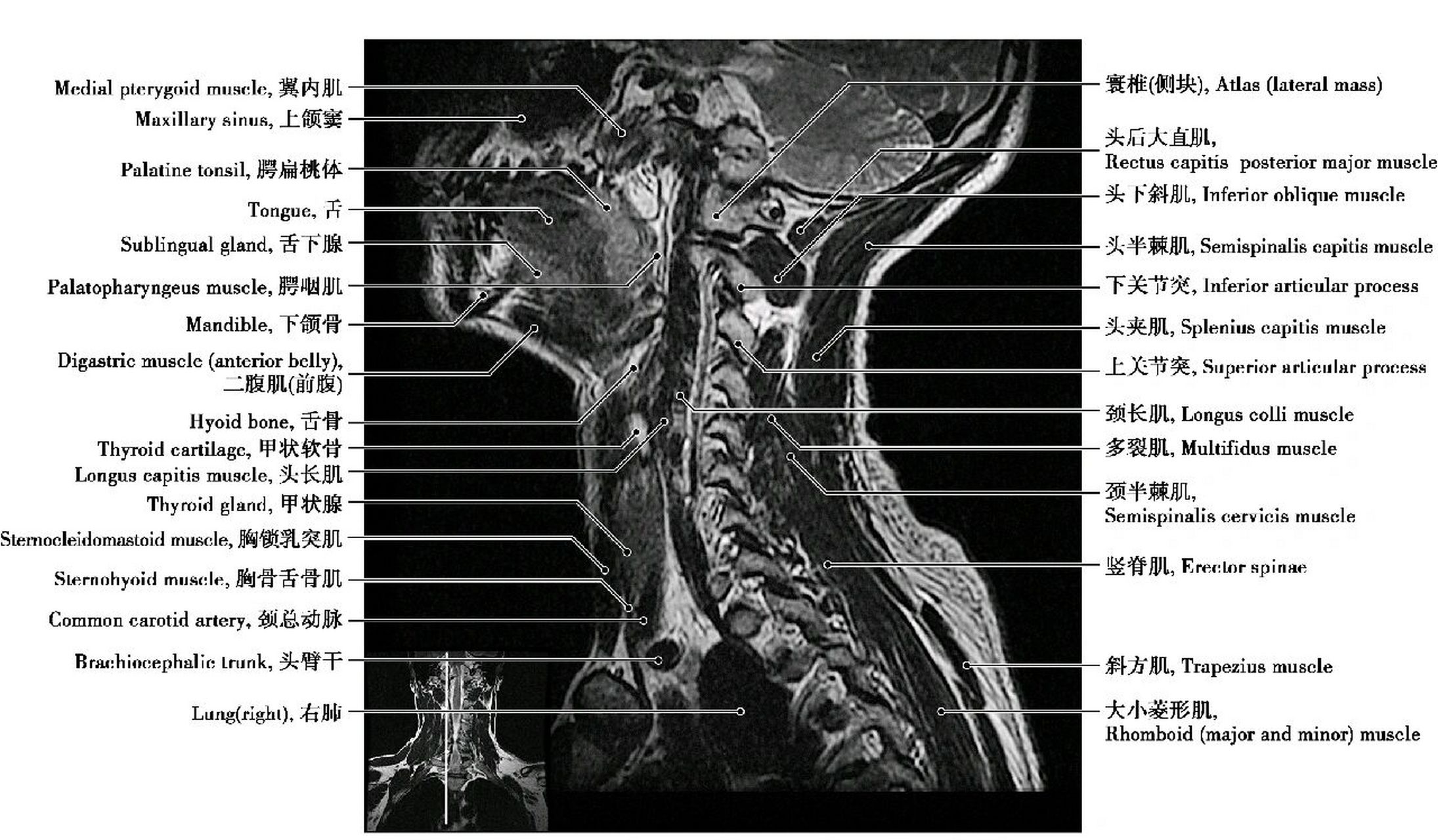 颈椎磁共振解剖图片