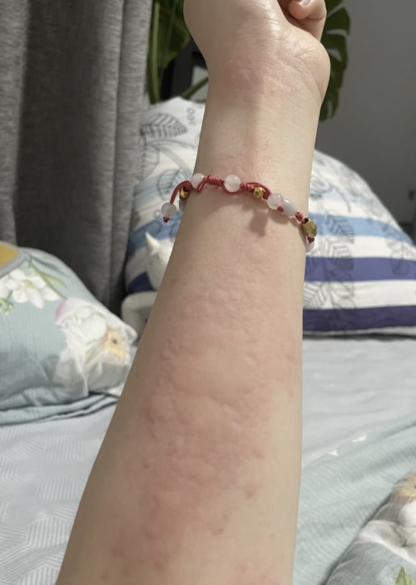 荨麻疹变成大片红斑不消退怎么回事?