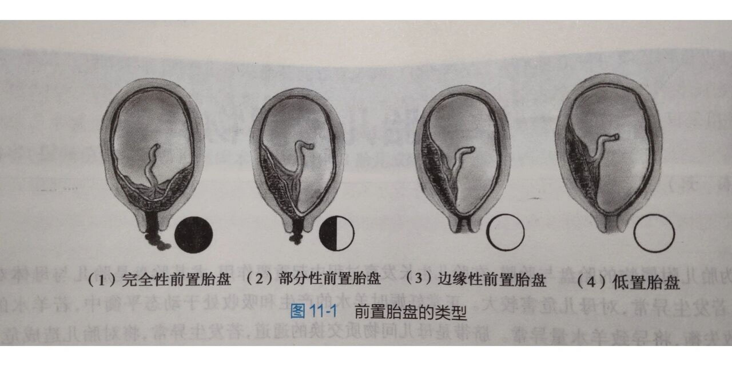 前置胎盘胎盘早剥图片