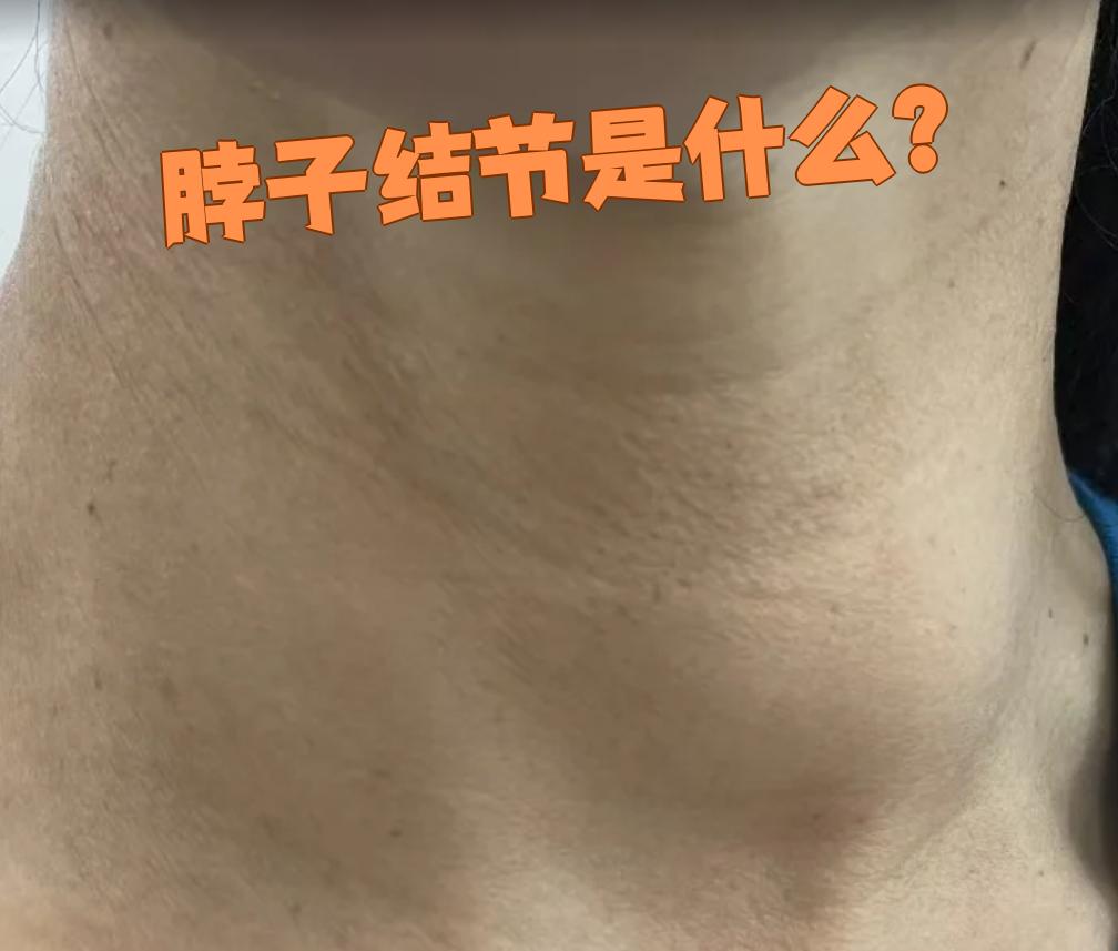 甲状腺结节是甲状腺里长的小肿块