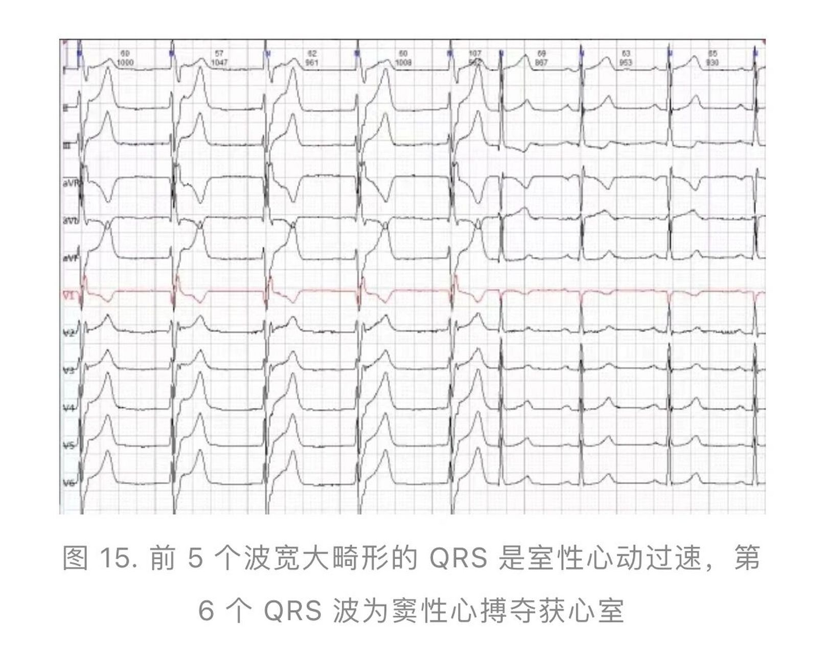 心室夺获心电图 心室夺获的前提是在交界区或心室的异位起搏点控制