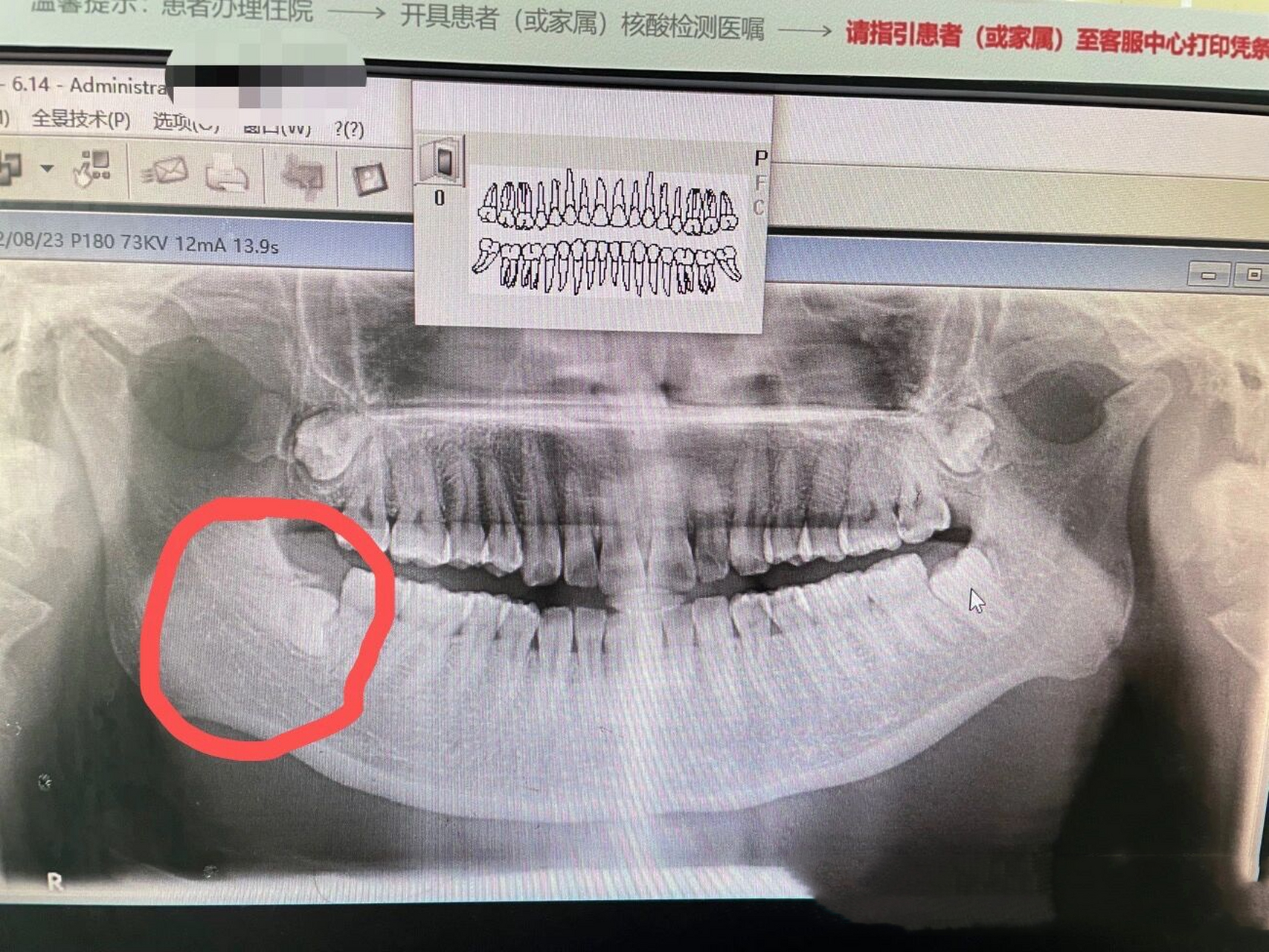 我还是挂了左主任的号,横向埋伏型阻生智齿,就在神经上方,由于这颗