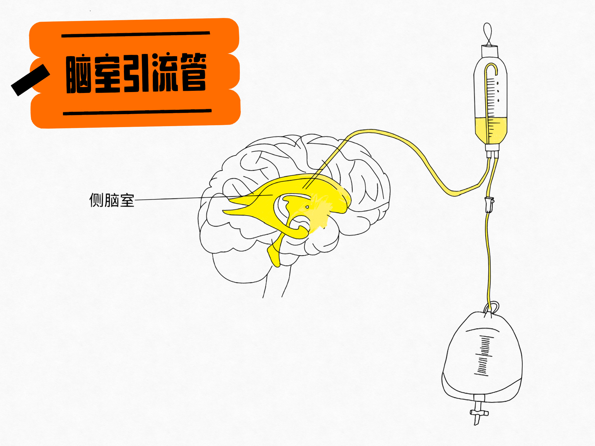 脑脊液引流术图片图片