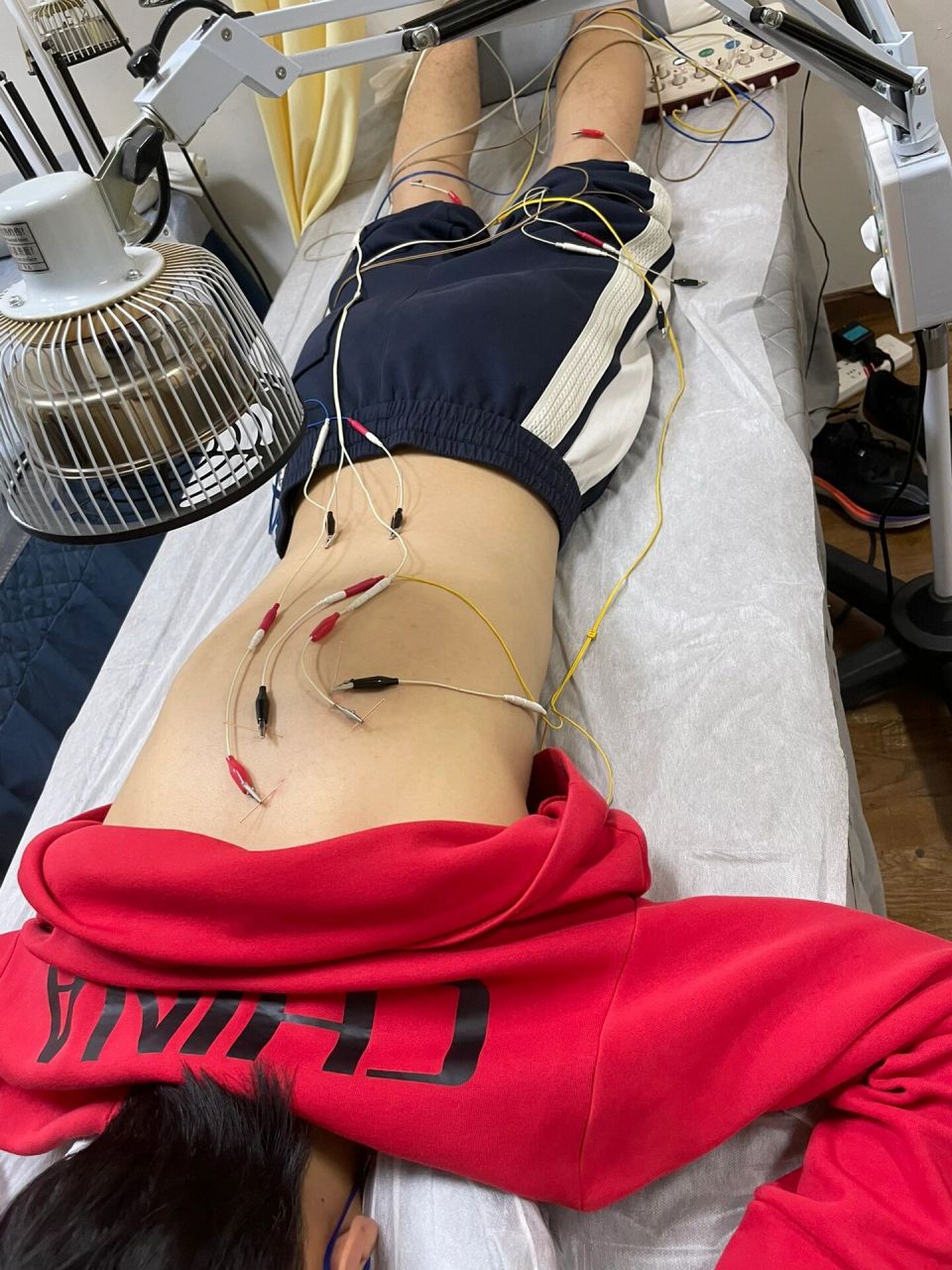 中医治疗背部肌肉拉伤 肌肉拉伤可以通过针灸治疗.