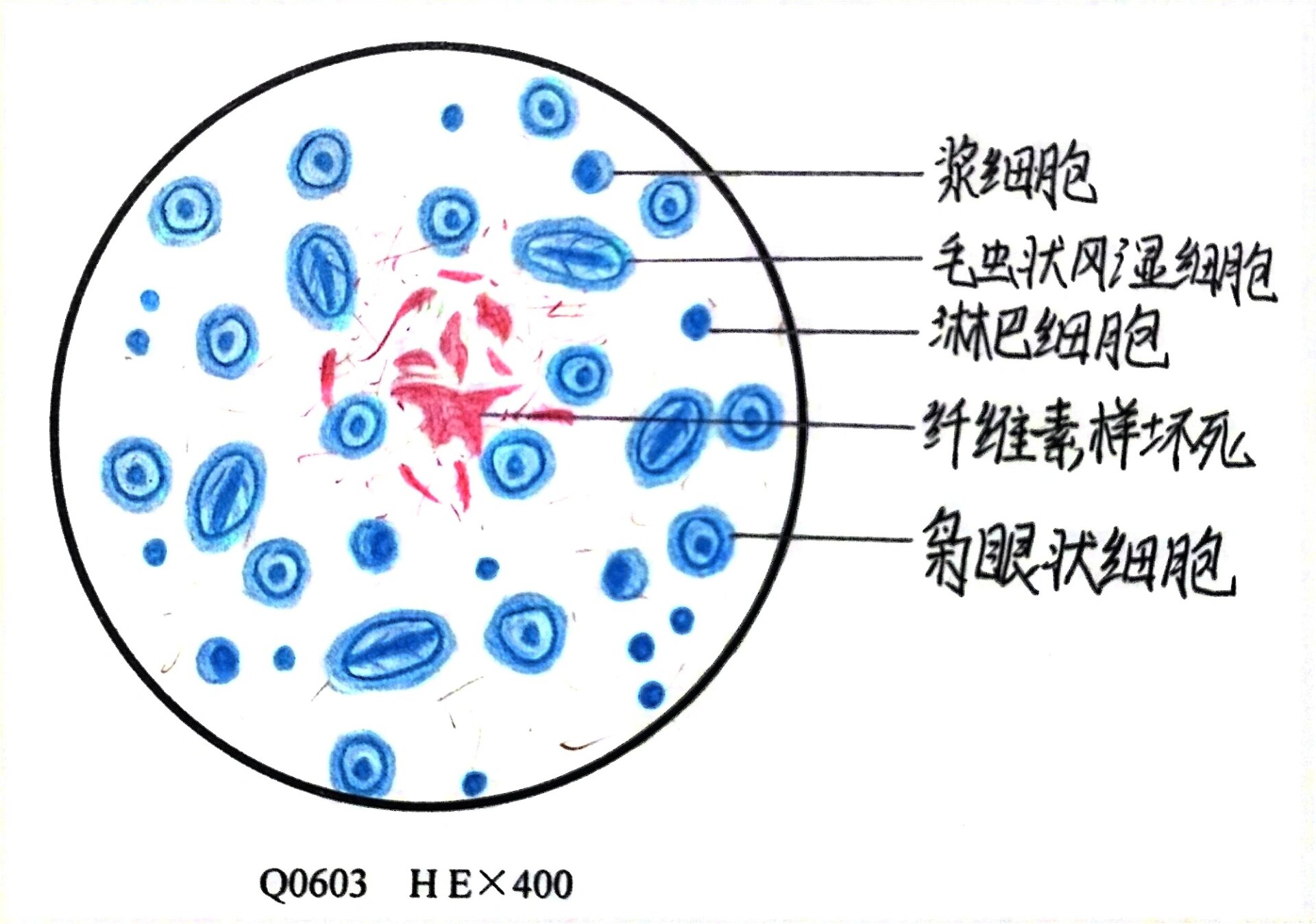 风湿小体