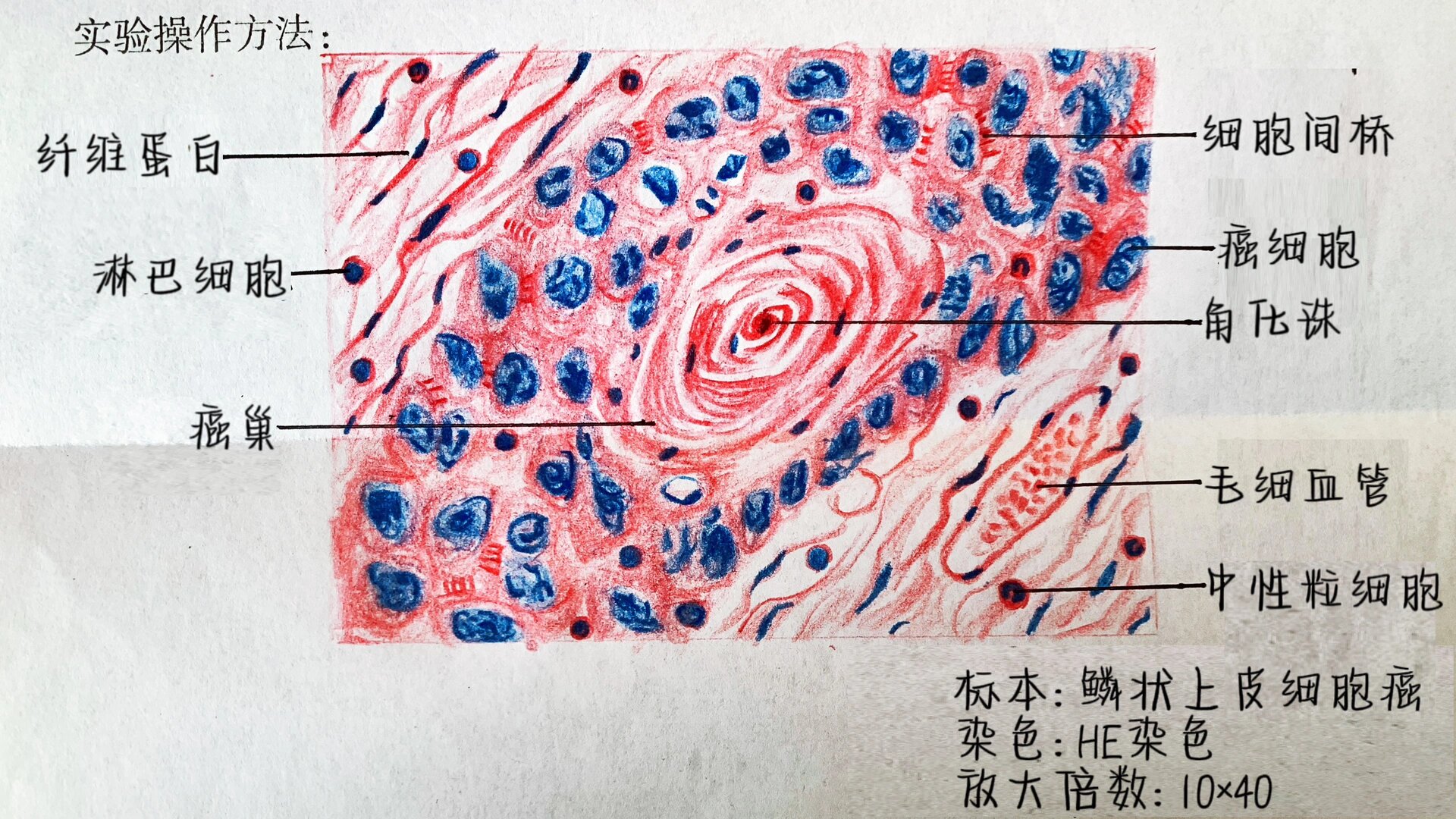 (全a)病理学实验报告(鳞状上皮细胞癌) 镜下可见: 癌巢由多层细胞构成